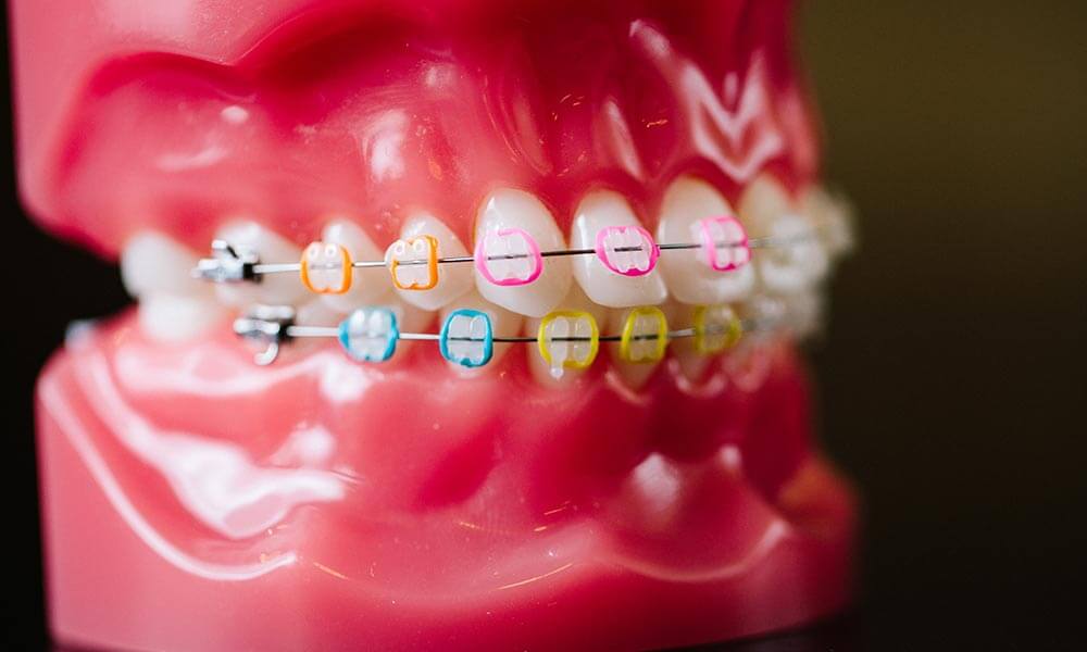 An example of dental metal braces.