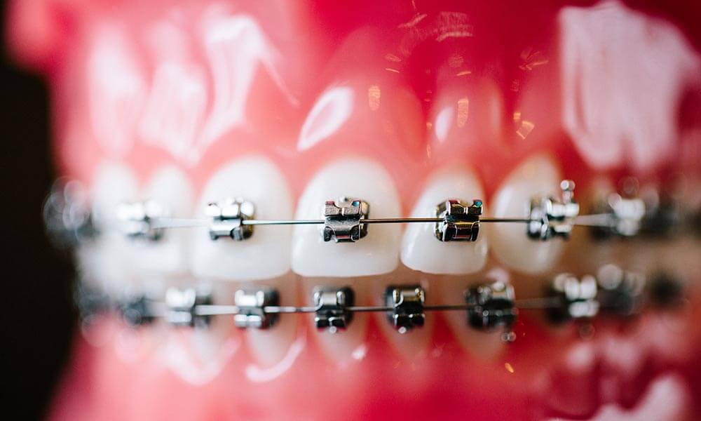 An example of dental metal braces.