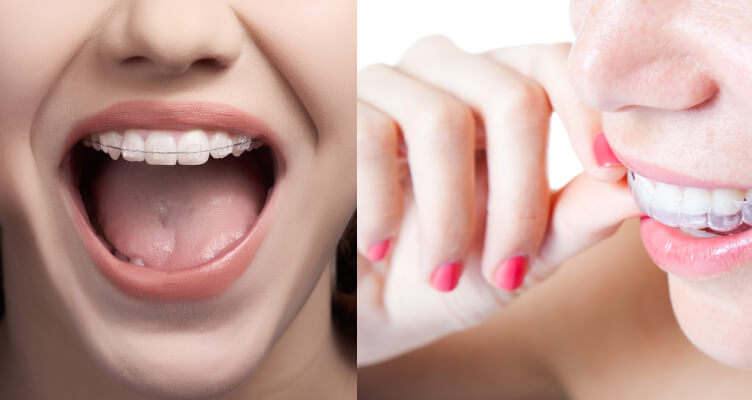 girl with braces and girl with invisalign