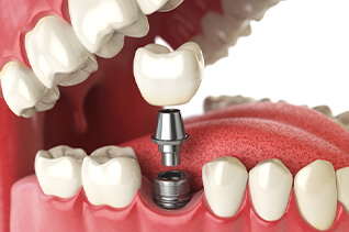 dental implant graphic