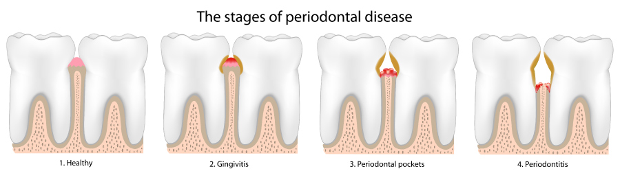 Graphic showing the stages of periodontal or gum disease