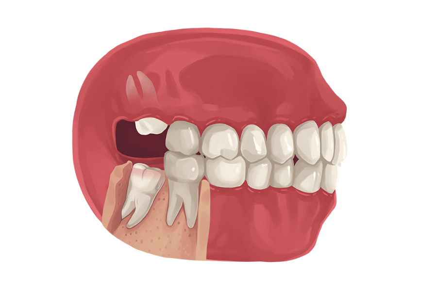 Model showing the jaw with upper and lower wisdom teeth emerging at bad angles