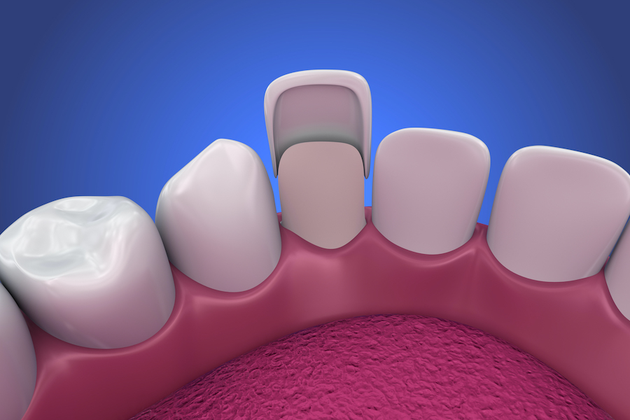 Close up of dental veneers on teeth