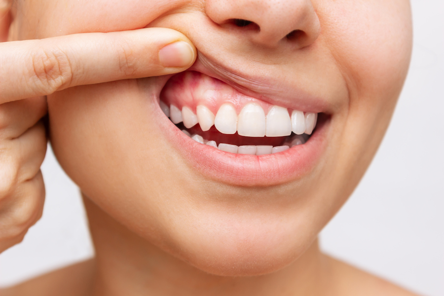 Closeup of a woman holding up her upper lip to show her healthy gums after gum treatment