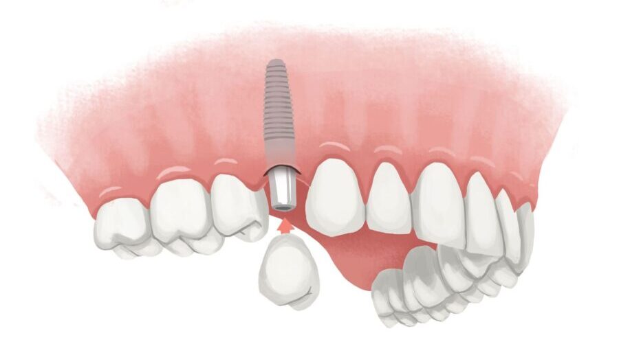 Illustration of a dental implant replacing a missing tooth in an upper jaw