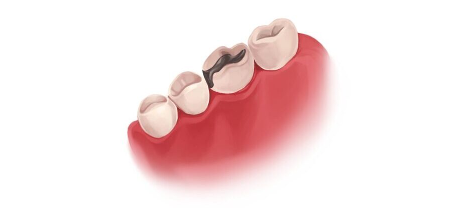 Illustration of a silver amalgam filling