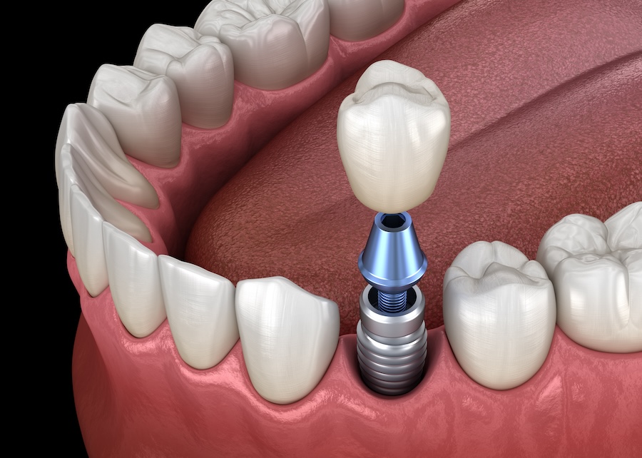 dental implant, dental implants, missing tooth, missing teeth, dentist in Farmington